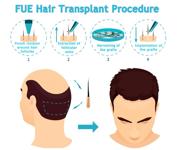 FUE hair transplant procedure, FUE hair transplant cost