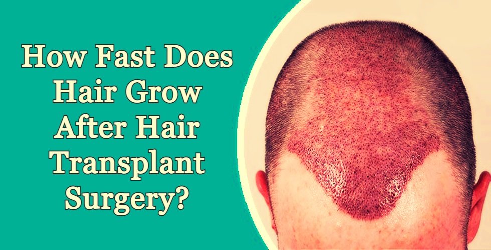 After Hair Transplant Surgery, Hair Transplant Growth Timeline,